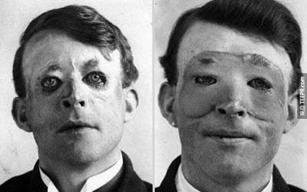 Walter Yeo (因脸部受创)，第一位做整形和皮肤移植手术的男人 - 1917