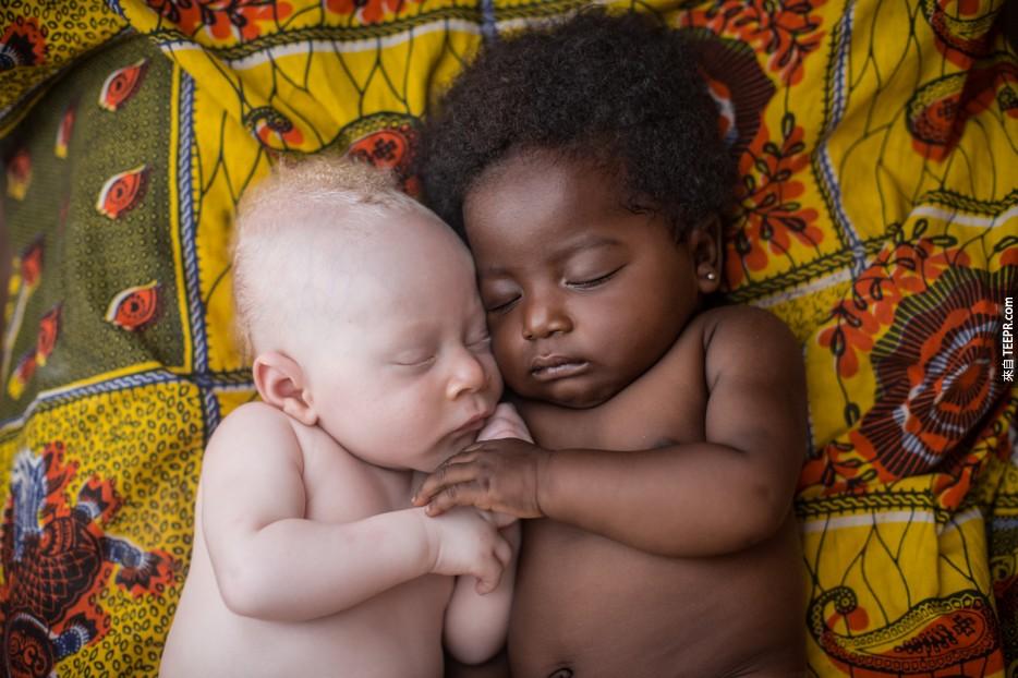 患先天白化病的3个月婴儿跟她的表哥睡午觉。