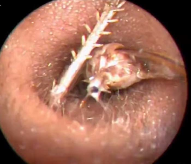 医生发现他耳朵里头，有只大蟋蟀，不停地往耳道钻。