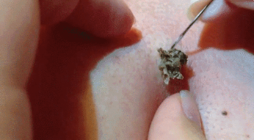 14 Confusing Moments Of Relief For Everyone Who Loves Popping Pimples
