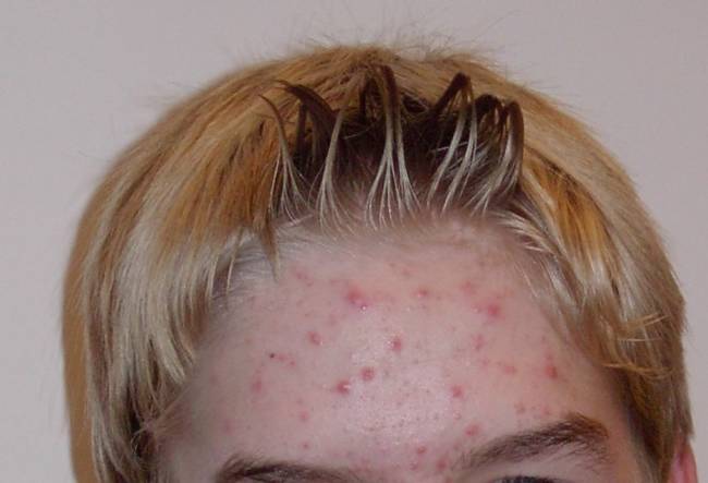 5.)青春痘是因為毛孔中長期累積的白頭及黑頭粉刺所引發，有些人在青春期時會發生青春痘的困擾，不過也有時會發生在成人身上