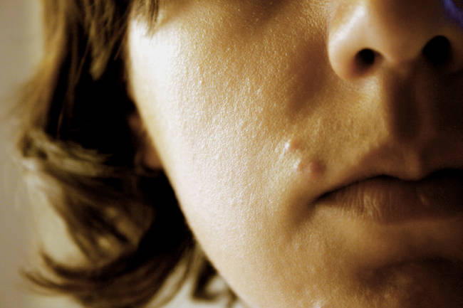 6.) 痘痘是因为毛孔堵塞，进而发炎所产生的，可能引发疼痛不适感。