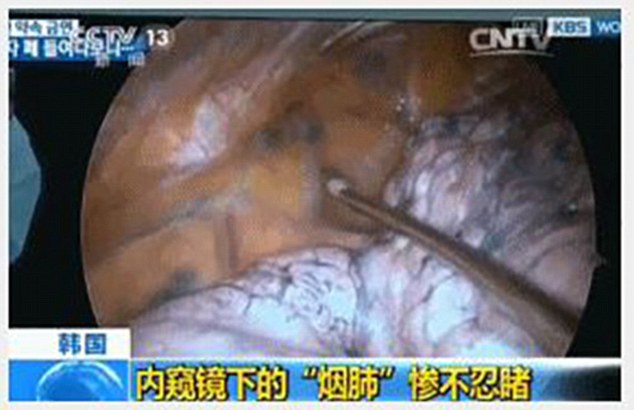 中國中央電視台 (CCTV) 日前播出了一段駭人的影片，讓長期吸菸的人能更真實地看到煙癮的後果。