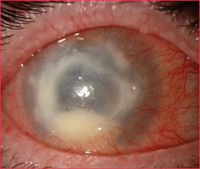 Corneal transplants can sometimes reverse the damage of Acanthamoebic keratitis. Most of the time, the patients stay blinded because the infection is notoriously difficult to get rid of.