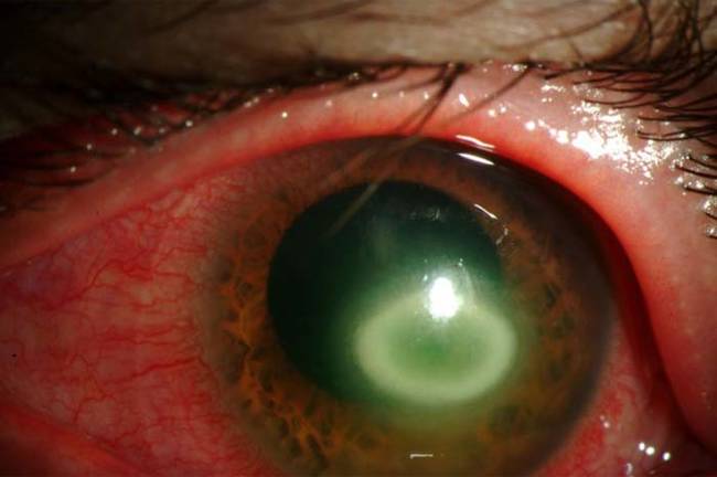 这位高姓女大生的眼睛看起来就像这样而且她已经失明了，阿米巴原虫引发的角膜炎可能会造成一点红肿或疼痛，但通常不会严重到让人想就医治疗。