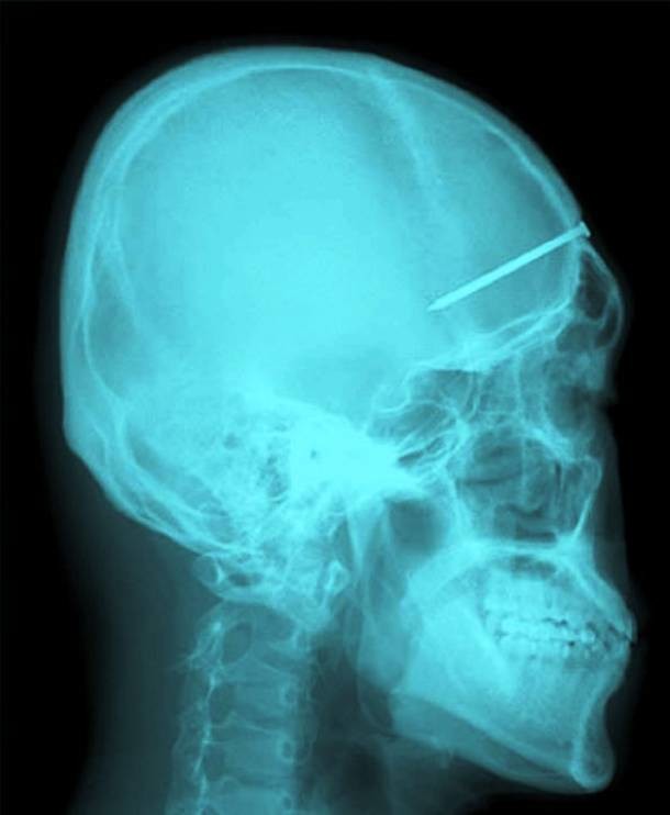Believe it or not, this guy didn't know he had a nail in his head...until he saw the X-ray.