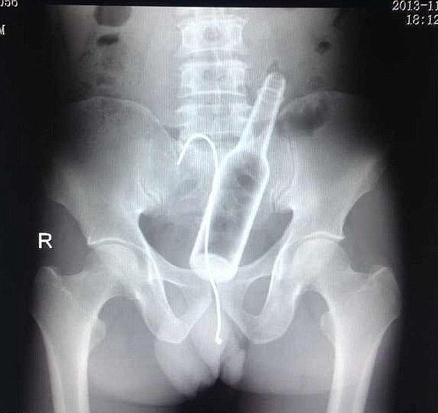 This man denied that he had put a bottle up his rectum and tried to remove it with a wire. The doctors had to show him the X-ray to get him to admit it.