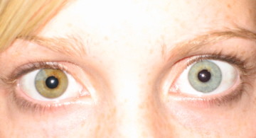 <em>Popula duplex </em>may not be well documented (or real), but here are number of conditions that people do have. For example, <em>heterochromia</em><em> iridum, </em>which causes separate coloration of the irises.