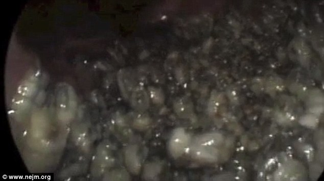 The man came to hospital complaining he had seen what appeared to be worms emerging from his nose. It turned out had more than a hundred maggots buried in his sinuses (pictured)