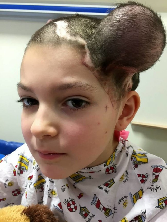 After the initial procedure was complete, a fourth balloon was placed on the side of her head. This was to provide skin to replace the extra bit of the mole that reached past her natural hairline and onto her face.