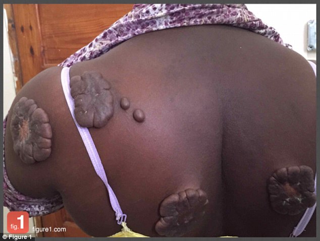 Anything in the photos that could potentially identify patients is supposed to be removed by the person uploading the photo. Pictured is a female patient with multiple massive keloids across her back
