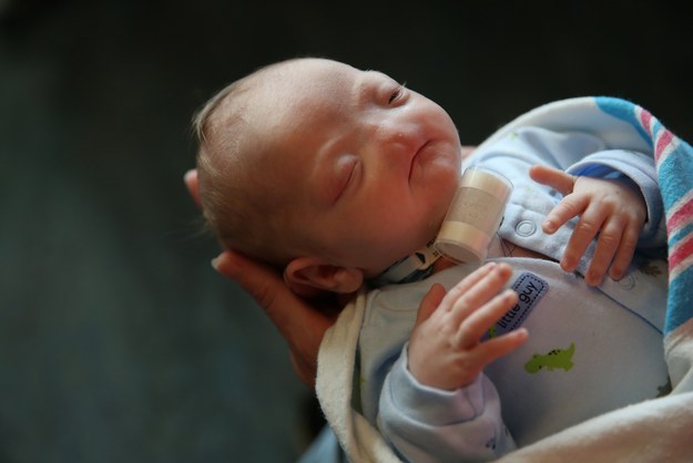 没有鼻子的他，出生当下立刻倚赖嘴巴来正常呼吸。直到出生5天后，医生用了气管切开术 (Tracheotomy) 来帮助他呼吸，他妈妈也说在手术后，他是「更快乐的小宝宝」了。