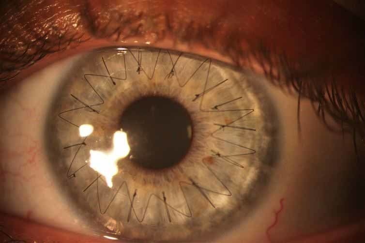 A transplanted cornea.