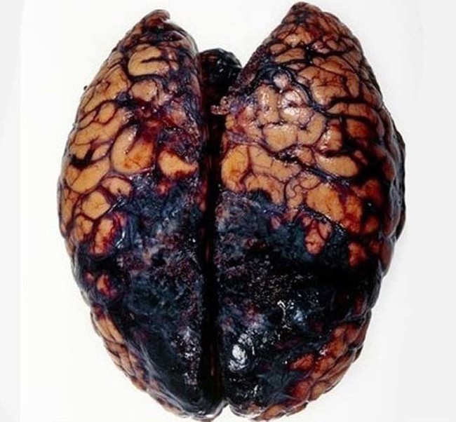 This is the ugly result of a deadly brain hemorrhage.
