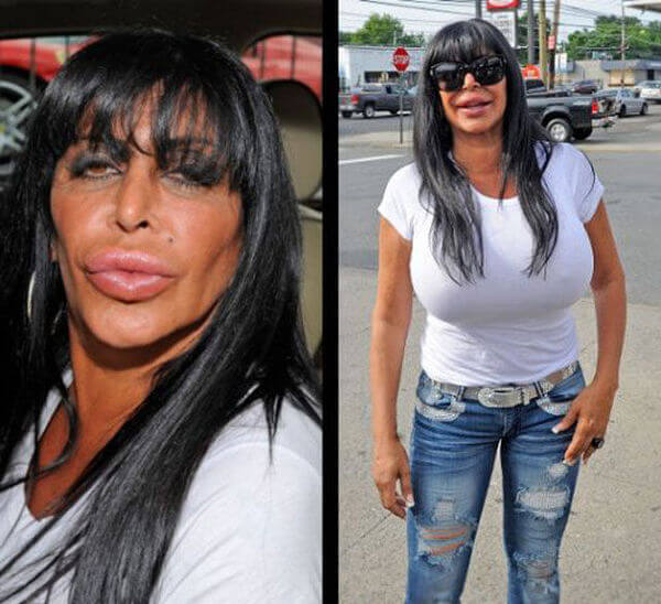 plastic surgery gone wrong 31