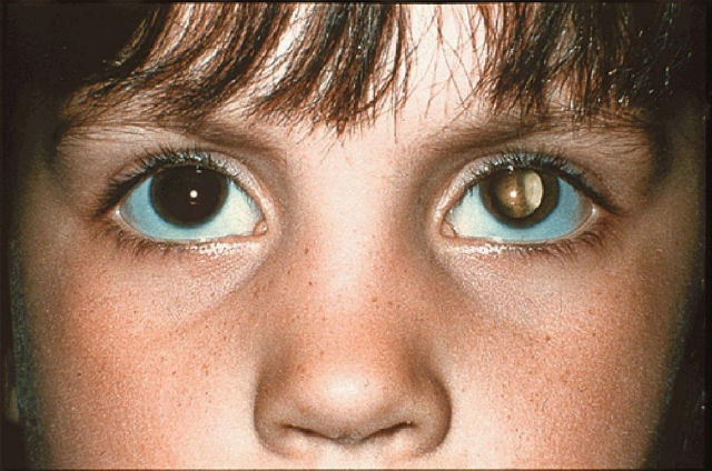 If you see a photo of a child with a reflection or red-eye in ONLY one eye, it could be a sign of retinoblastoma (a type of eye cancer).