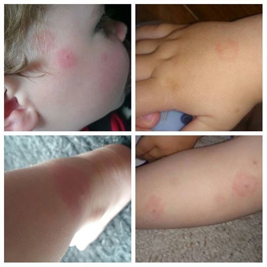 One of the most common early signs is a rash that radiates out from the site of the bite within a few days.