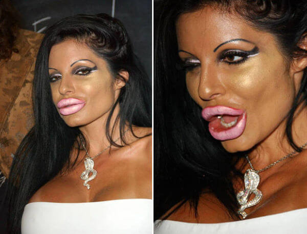 plastic surgery gone wrong 17