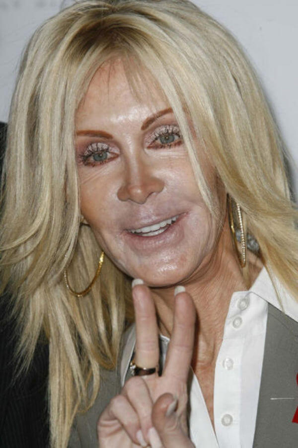 plastic surgery gone wrong 11