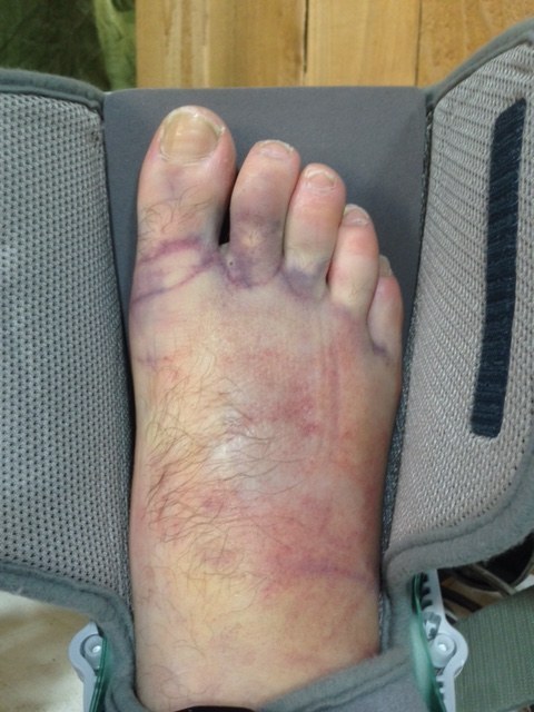 The swelling was just beginning to go down when he noticed a bump on the top of his foot.