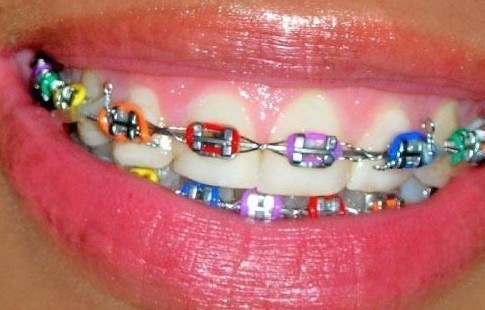 Multicoloured metal braces.