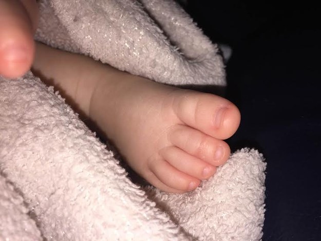 In Molly's case, her mom quickly removed the hair from her toe with a magnifying glass and tweezers. Walker said the baby's foot is healed, but he realized the situation could have been much worse.