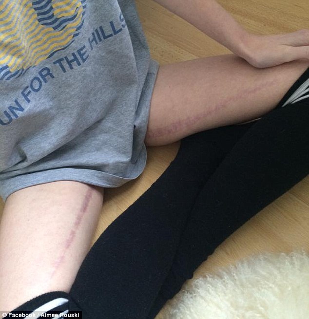 Aimee also posted a picture of the scars on her legs left behind from surgery. Her inner thigh muscles were removed to cover her external wounds 