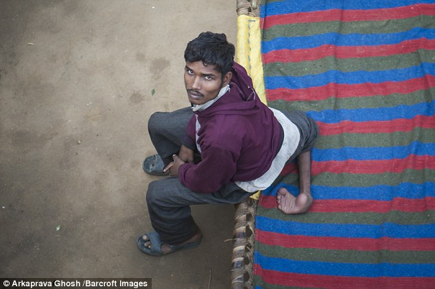 Arun Kumar (pictured) carries his extra legs on his back, which is damaging his posture