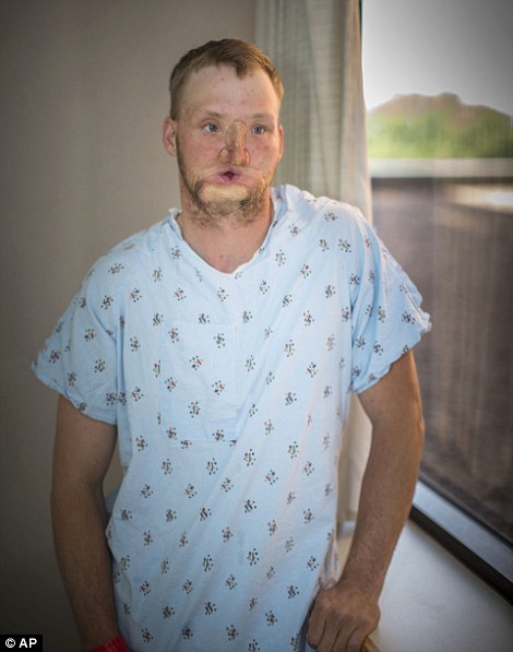 Before his transformation: This picture taken at the Mayo Clinic in June of 2016 shows the progress surgeons had made on him over the past decade since he tried to end his life by shooting himself in the head before Christmas in 2006