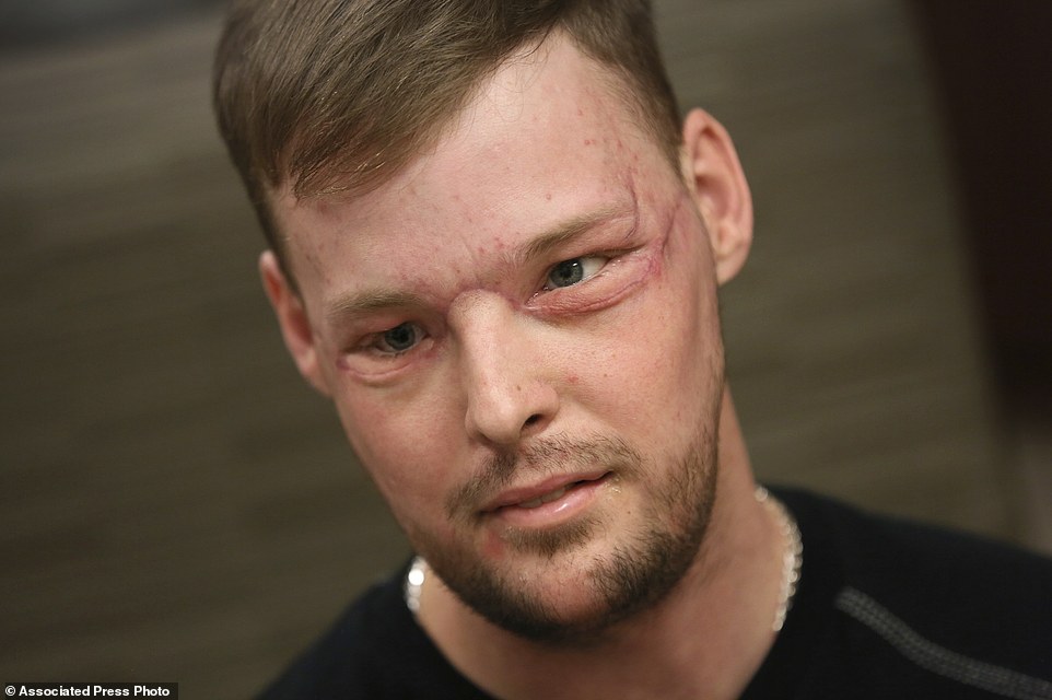 Staggering transformation: Face transplant recipient Andy Sandness attends a speech therapy appointment at the Mayo Clinic in Rochester, Minnesota on January 27 - seven months after his face transplant operation was hailed a success 