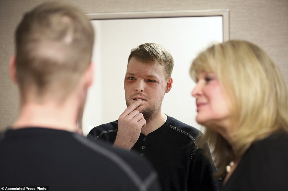 Re-adjustment: Andy Sandness looks in a mirror during an appointment with physical therapist Helga Smars at the Mayo Clinic. He wasn't allowed to see himself immediately after the surgery. His room mirror and cell phone were removed. When he finally did see his face after three weeks later, he was overwhelmed