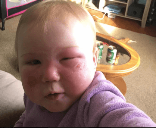 14個月女兒「臉上突然長出水泡」又紅又腫，母親哭訴：為什麼「這個產品」還在架子上？！