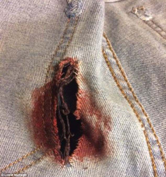 The shrapnel tore holes in the pair's clothing during the horror blast and left blood stains
