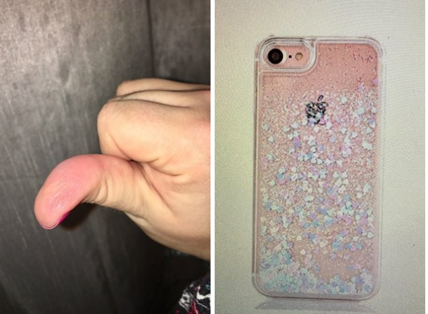 %e6%89%8b%e6%a9%9f%e6%ae%bc%e7%87%92%e5%82%b7