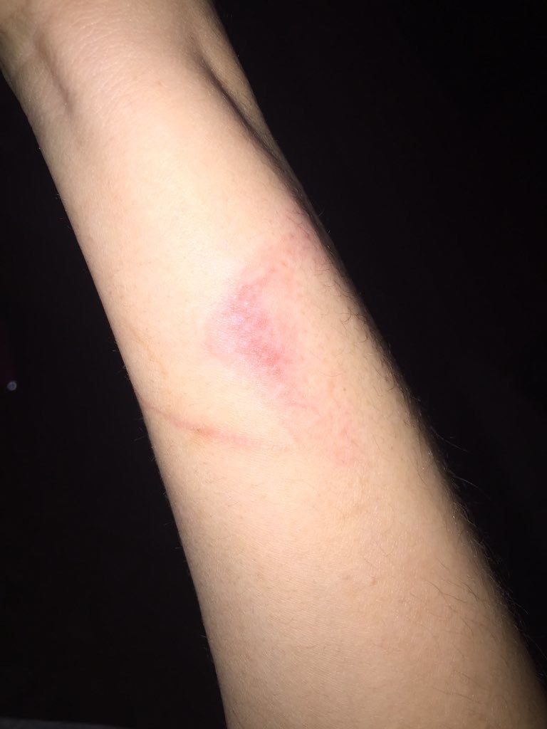 %e6%89%8b%e6%a9%9f%e6%ae%bc%e7%87%92%e5%82%b7