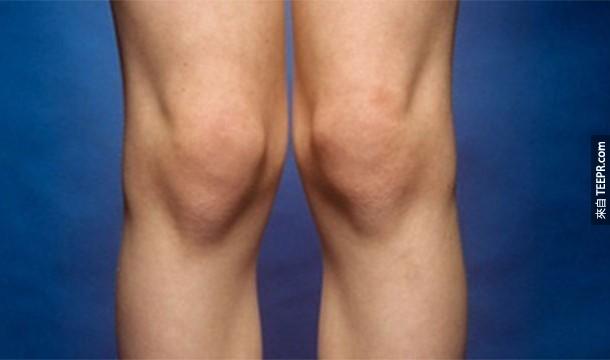 18. Genuphobia:膝蓋或下跪恐懼症