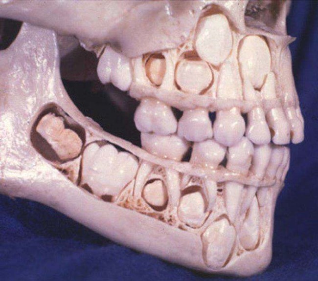 還沒掉乳牙前，人類的下巴看起來是這個樣子。