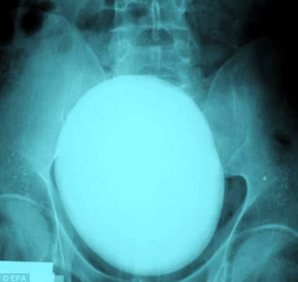 24 Most Shocking Things That Ever Got Stuck In The Human Body