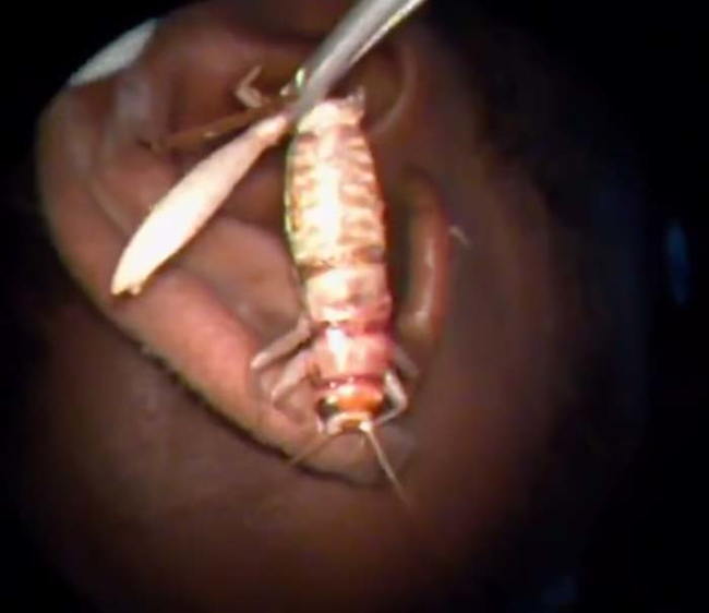 這是在印度坦米爾納德邦(Tamil Nadu)南區耳鼻喉科研究中心，醫生使用了小鑷子把蟋蟀夾出來。全程還有錄影呢...