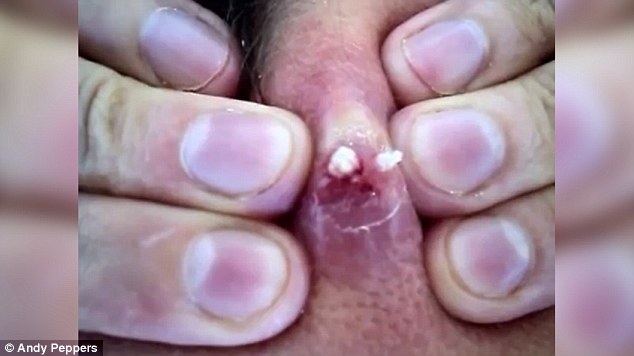 Mr Peppers asked his wife to unblock the pore with a pin, and as he squeezed white pus slowly came out