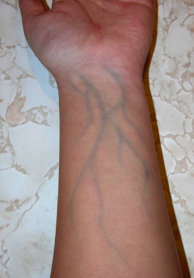 11.) Blue veins: Human blood in veins is not blue. Blood is always red due to hemoglobin, our veins just appear to be blue.