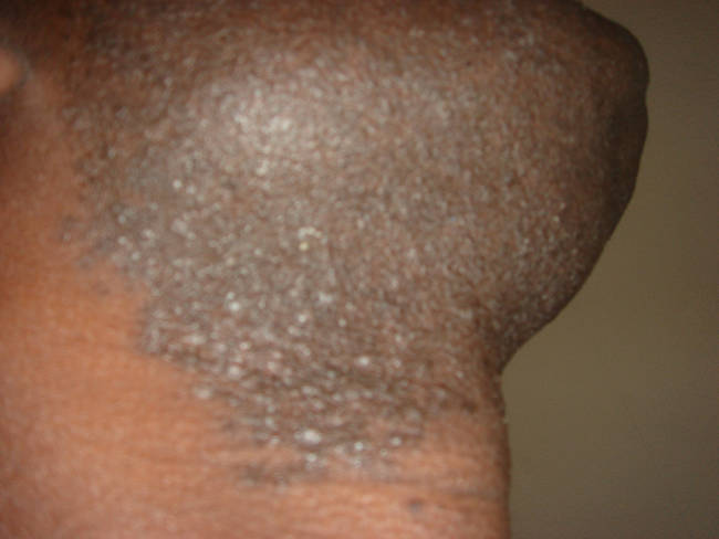 9.) 向内生长的毛发有时相当疼痛，毛发应该向外生长，却被卡在毛细孔内。