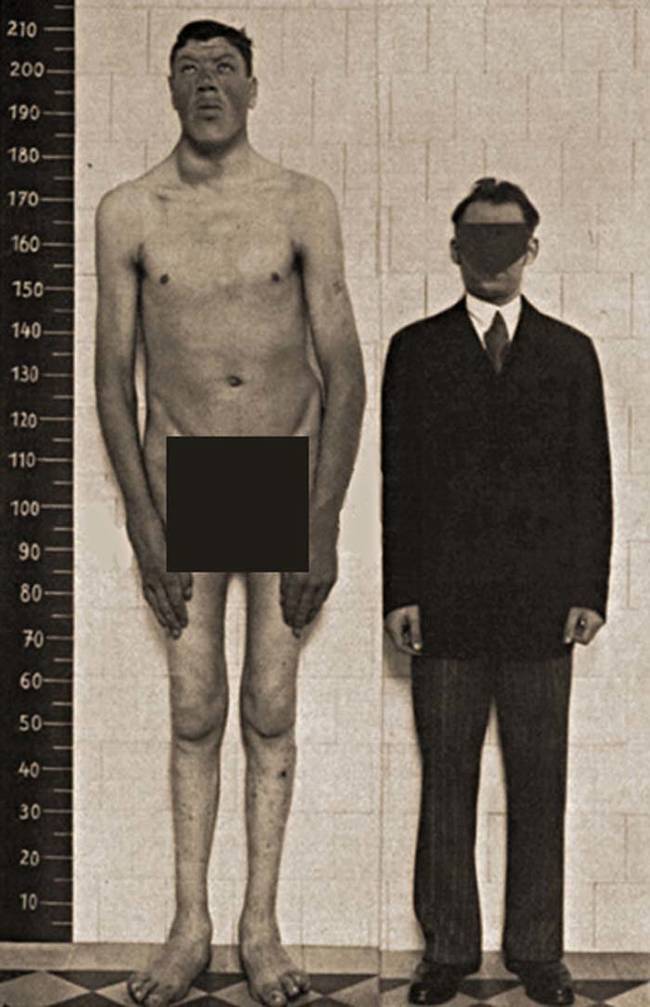 Rainer's growth spurt took the medical community by surprise. Doctors examined Rainer  to try to determine the source of his wild growth. The conclusion they reached was that a tumor on Rainer's pituitary gland was leading to an overproduction of growth hormones. Here you can see Rainer's height compared to a normal-sized man.