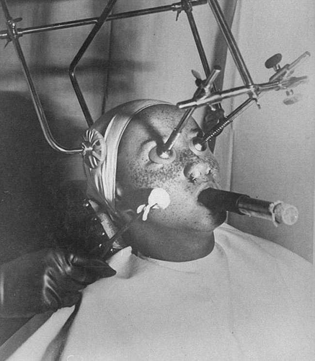 6. 在1930年代，當時的醫生想要運用二氧化碳冷凍技術來去除雀斑，儀器還會好好保護眼睛。此外，鼻子也會被塞起來，是透過嘴巴那根管子還呼吸的。