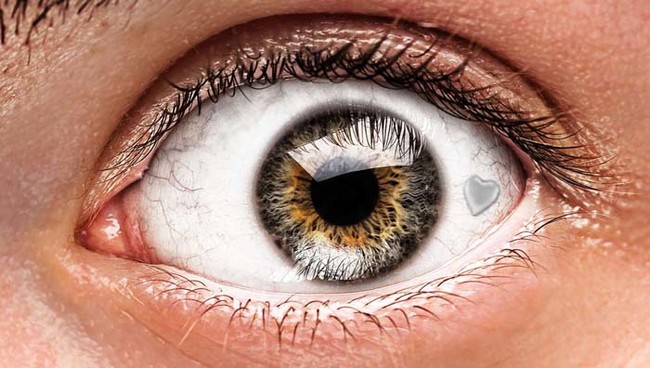 現在全世界只有一家診所做這樣的眼球植入手術，這個診所就是荷蘭的The Netherlands Institute for Innovative Ocular Surgery。