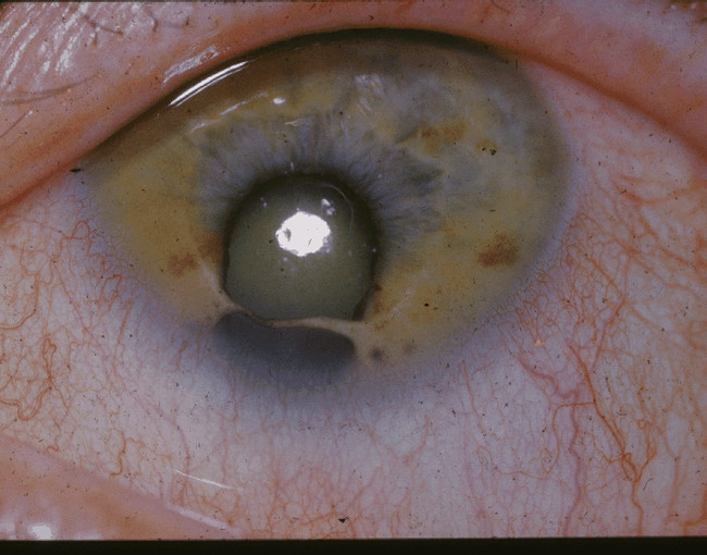 The horrifying <em>coloboma </em>is a birth defect that causes a hole in the iris. Most people who suffer from <em>coloboma </em>are also blind.