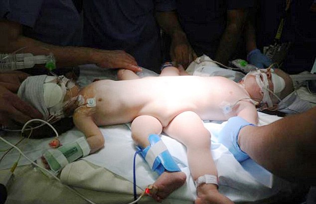 叶门 (Yemen) 有对下半身相连的连体婴Abdullah和Abdulrahman，原先他们的肠道、泌尿系统、还有骨盆都有相连，直到他们被带到了沙乌地阿拉伯 (Saudi Arabia) 接受了长达9个小时的手术。