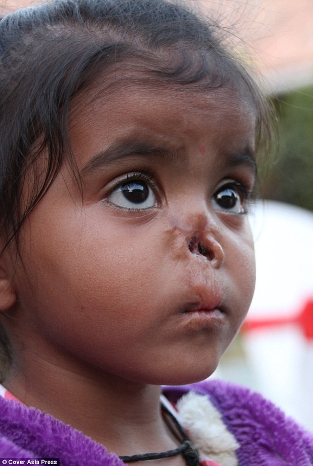 Durga was abandoned at birth, since then many parents have rejected her because of her deformity 