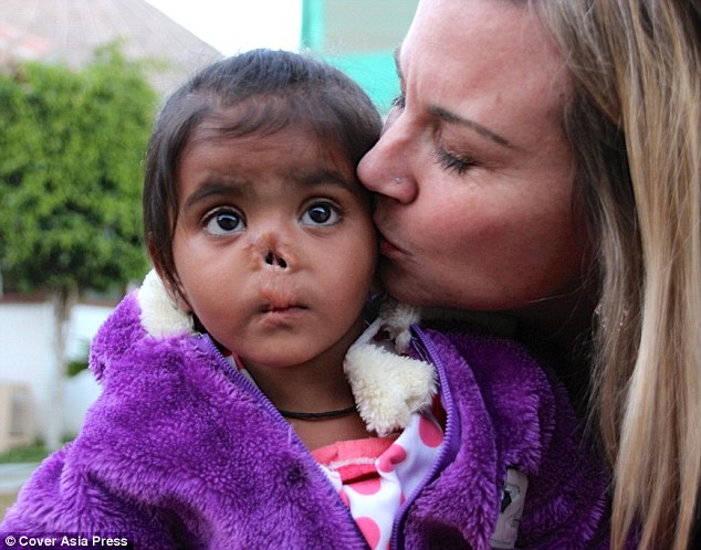 一名一出生就被丢弃的3岁印度女童Durga，因为没有鼻子的样貌，让她迟迟找不到愿意收养她的家庭。在一次又一次的拒绝后，她终于在今年找到了家。来自辛辛那提、44岁的Kristen Williams决定收养这位出生后鼻子被虫咬掉的女孩。  Durga现在已经在俄亥俄州开始了新的生活，她还一位8岁的妹妹Munni，Munni是Kristen在2012年于印度收养的另一位女孩。