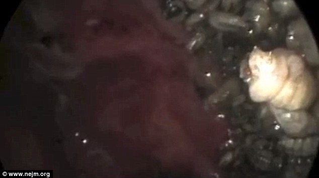 It took four days to clear the maggot infestation as doctors removed them individually, guided by a camera